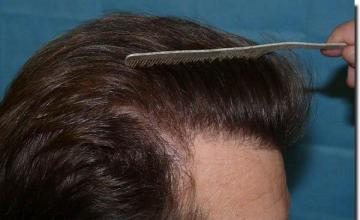 Hair restoration procedure results