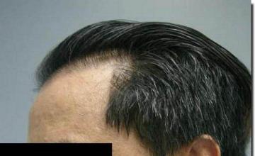 Hair restoration procedure results