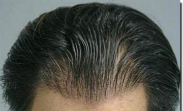 Hair restoration procedure results