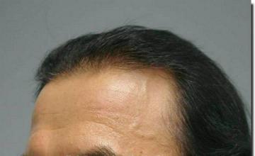 Hair restoration procedure results