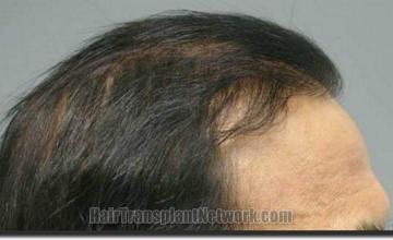 Hair restoration procedure results