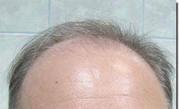 Hair restoration procedure results