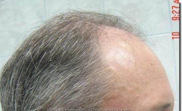 Hair restoration procedure results