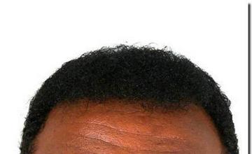 Hair restoration procedure results