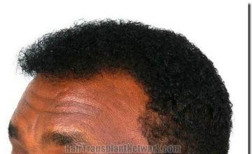 Hair restoration procedure results