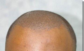 Hair restoration procedure results