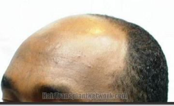 Hair restoration procedure results