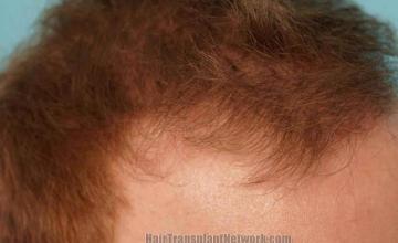 Hair transplantation surgery before and after photos