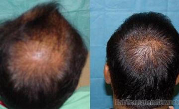 View of back before and after hair restoration procedure