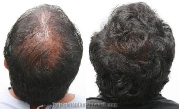 Surgical hair transplantation result photographs