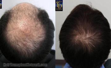 Hair restoration procedure before and after pictures
