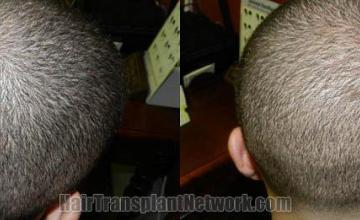 Hair restoration procedure before and after pictures