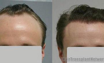 Hair transplant result photos - Front view