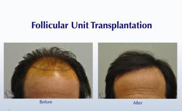 Front view - Before and after hair transplant surgery