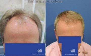 Hair restoration procedure before and after results