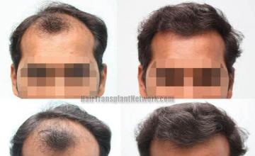 Hair restoration procedure before and after results