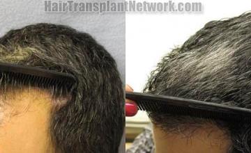 Hair restoration procedure before and after pictures