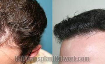 Hair transplantation surgery before and after images
