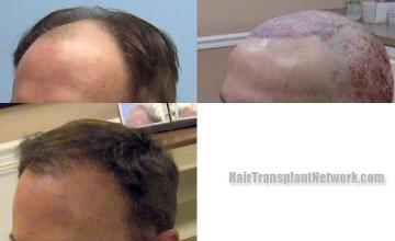  before and after images