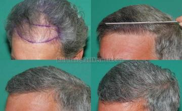 air transplantation surgery before and after photos