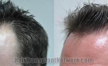 Hair transplantation surgery before and after images