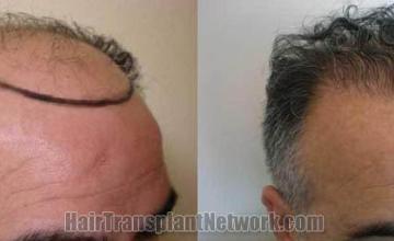 Hair transplantation surgery before and after photos