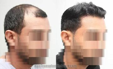 Before and after hair transplantation result photographs