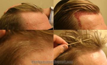 Hair transplantation surgery before and after photos