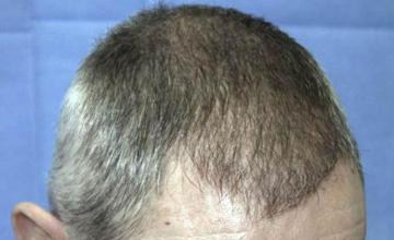 Hair transplantation surgery before and after images