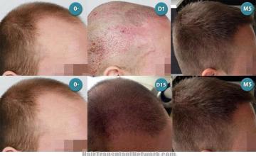Hair transplantation surgery before and after images