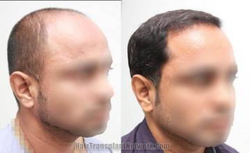 efore and after surgical hair restoration images