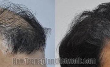 Hair transplantation surgery before and after pictures