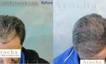 Hair transplantation surgery before and after images