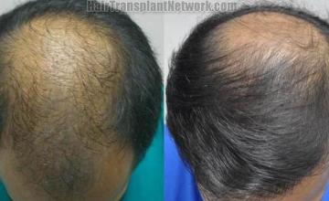 Before and after hair transplant procedure images