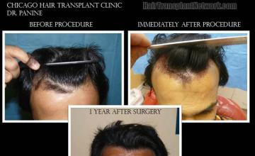 Before and after hair transplant procedure images