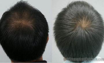 Back view of Thai male from hair replacement