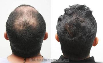 Hair transplantation surgery before and after images