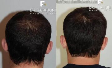 Hair transplantation surgery before and after images