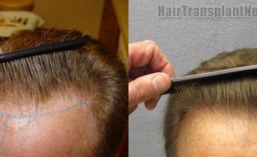 Hair restoration procedure before and after results