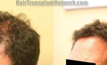 Hair transplantation surgery before and after images