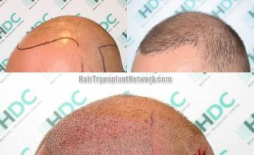 Hair transplantation surgery before and after pictures