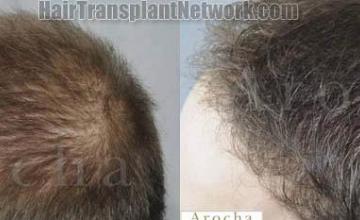 Hair transplantation surgery before and after images