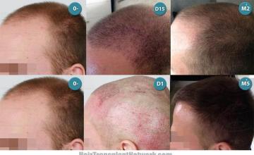 Hair transplantation surgery before and after pictures