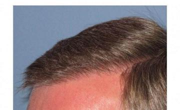 Closeup view of hair restoration results