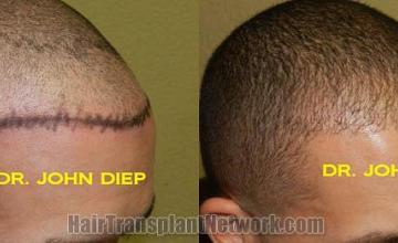  before and after pictures