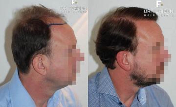 Hair restoration procedure before and after results