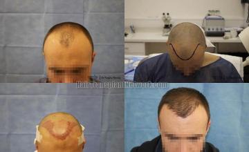 Hair transplantation surgery before and after photos