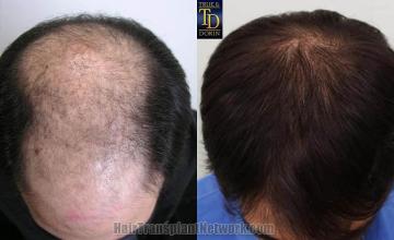 Hair transplantation surgery before and after photos