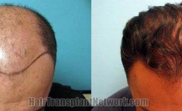 Hair transplantation surgery before and after photos