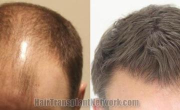 Hair transplantation surgery before and after images